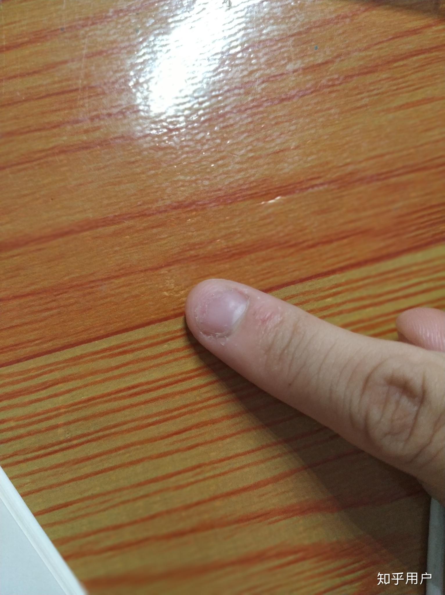 指甲缝很痒抠着就发现指甲越来越短了怎么办