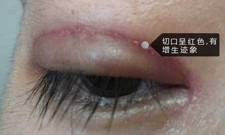 请问这是发炎吗双眼皮术后21天了一直在忌口