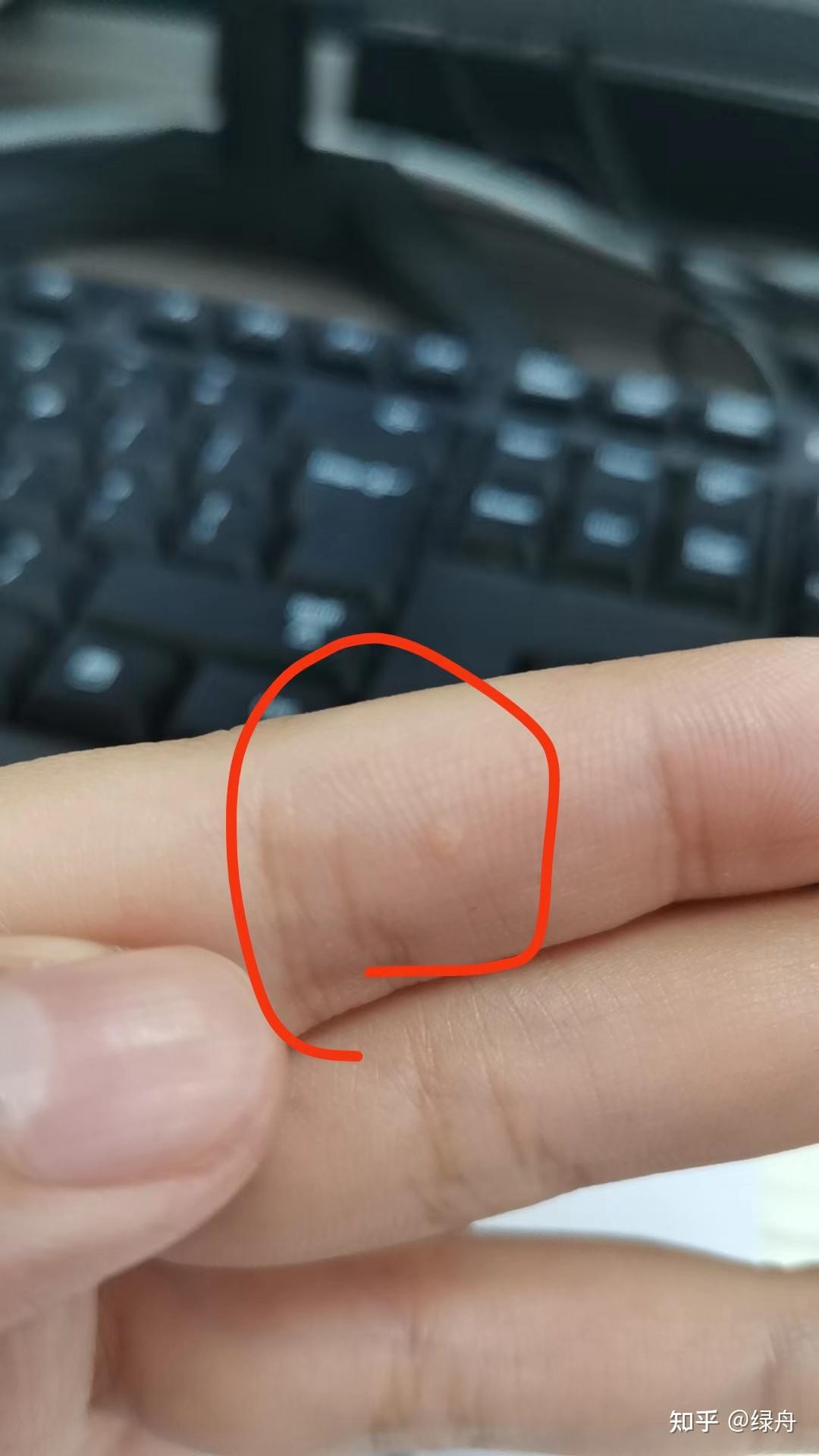 小孩手上长了一个疣怎么办?