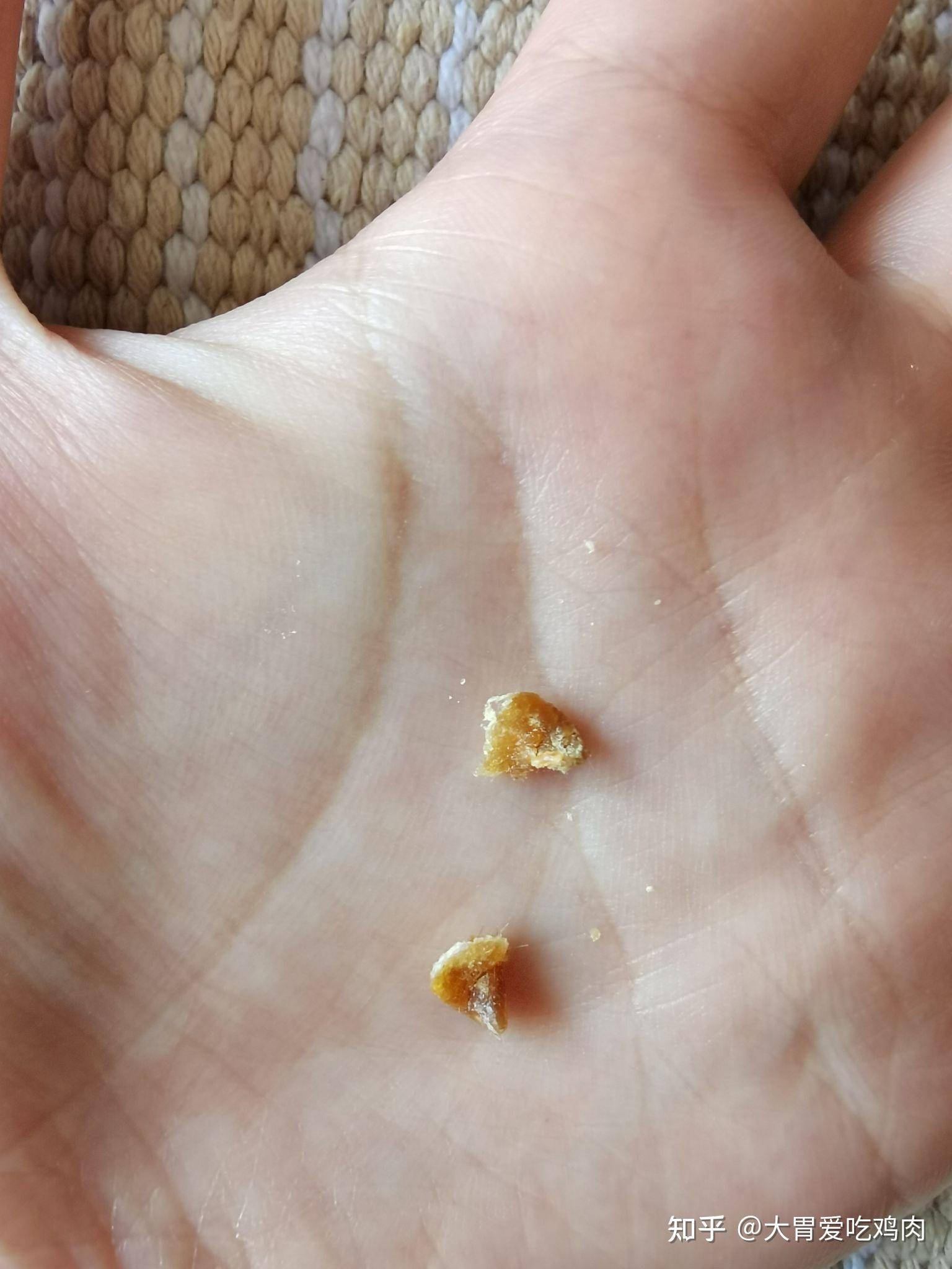 3岁女宝耳朵的耳屎堵住怎样清理? - 知乎