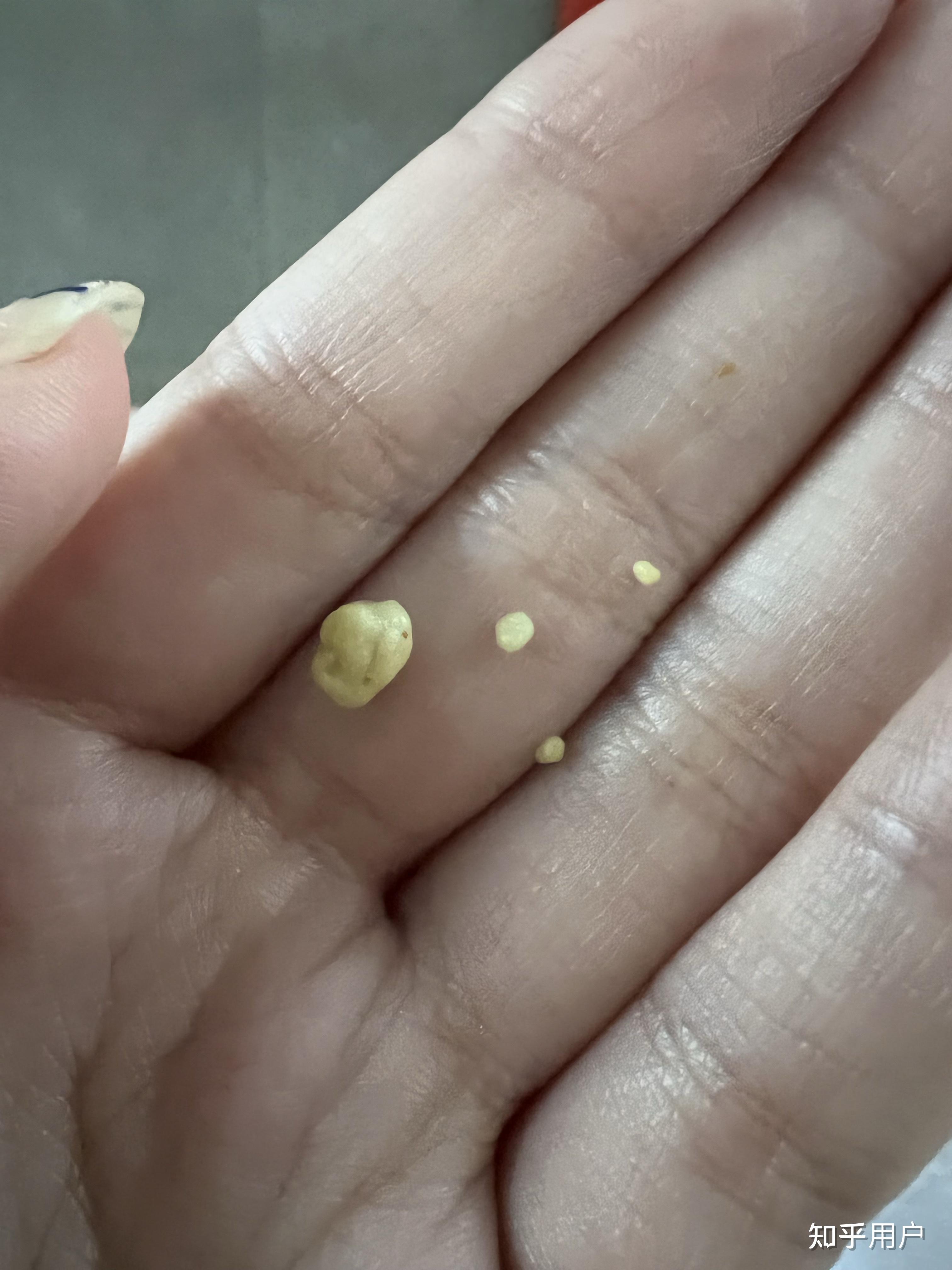 你见过最大的扁桃体结石有多大? - 知乎