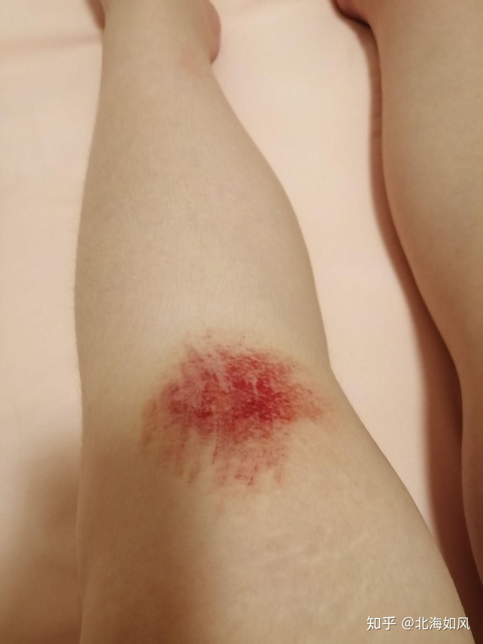 骑车侧翻膝盖摔伤破皮,怎么处理伤口,怎样才能不留疤? 