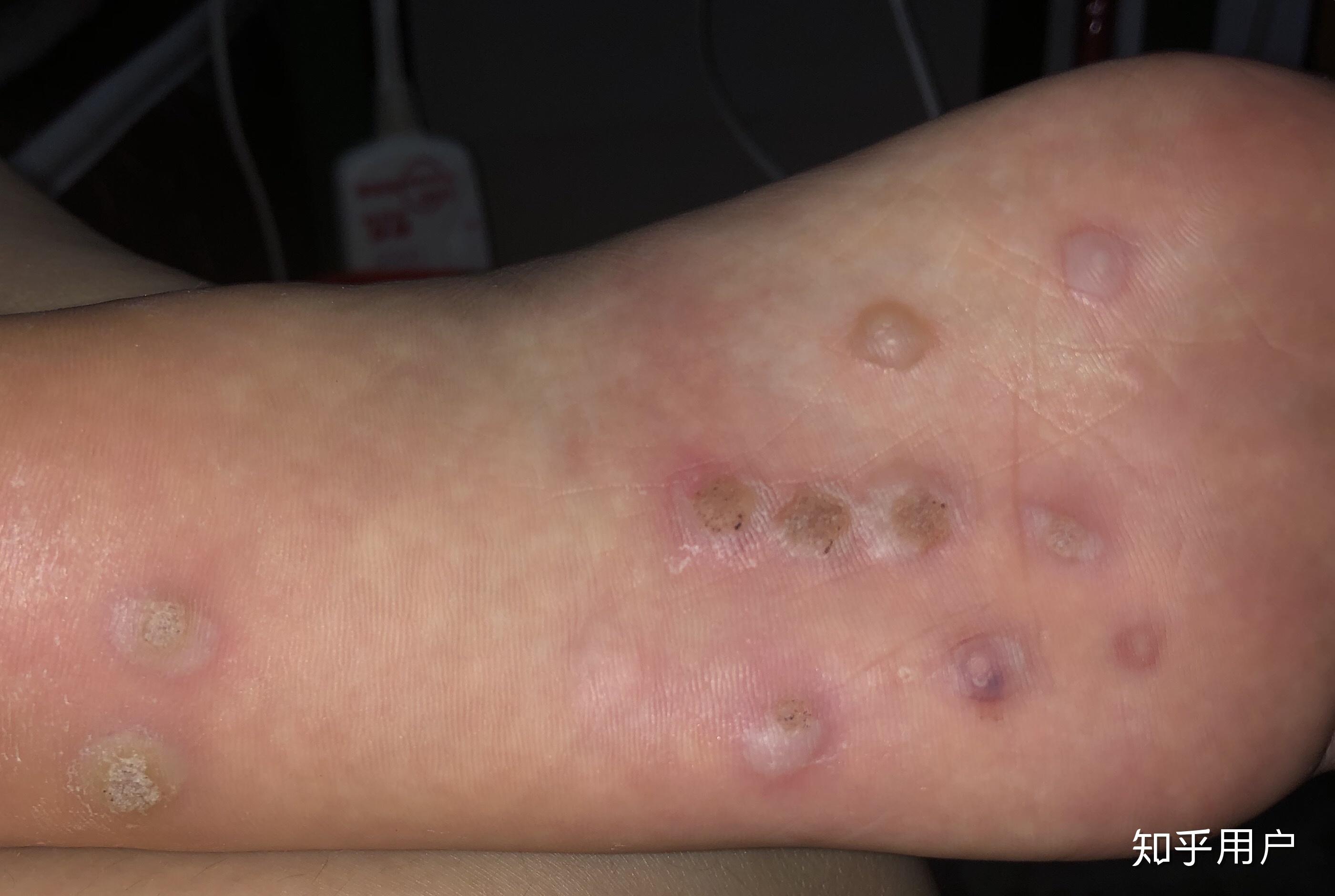 脚上长病毒疣怎么治? - 知乎