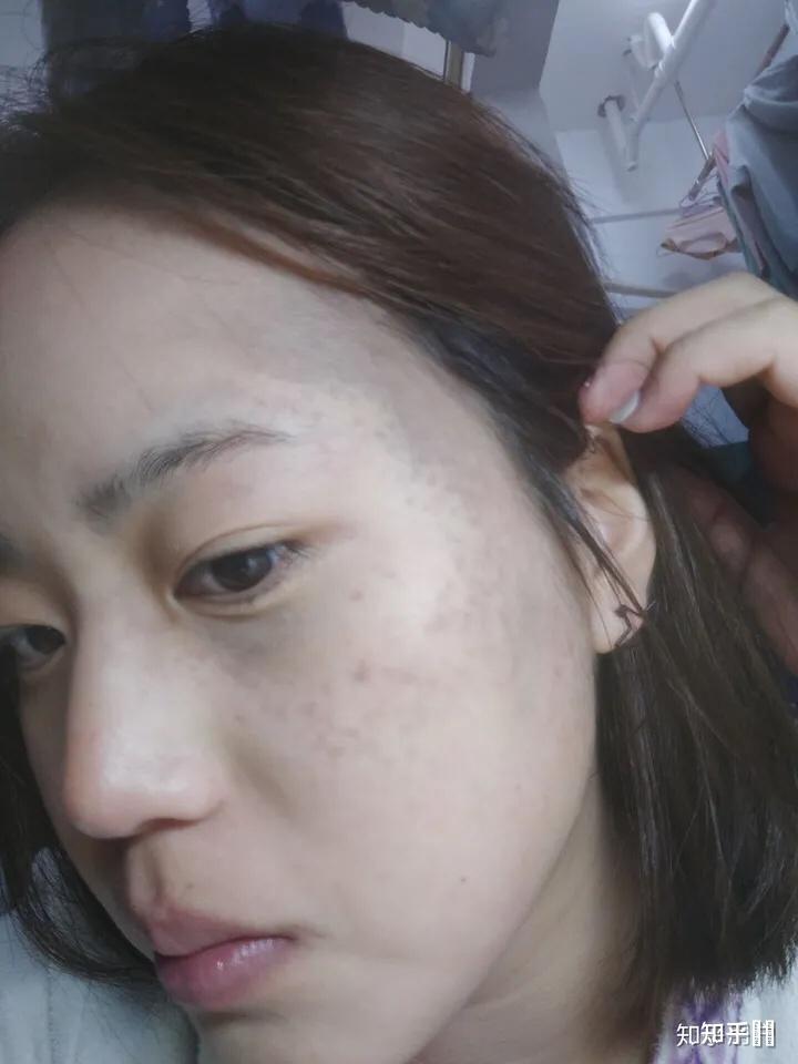 太田痣激光手术后几天可以见人呢