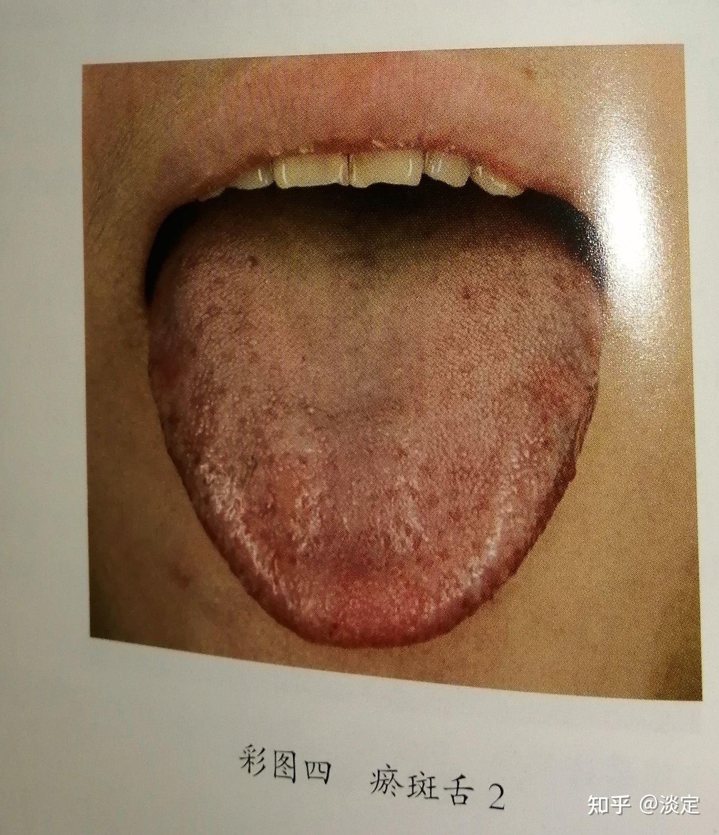 舌头有瘀点瘀斑图片-图库-五毛网