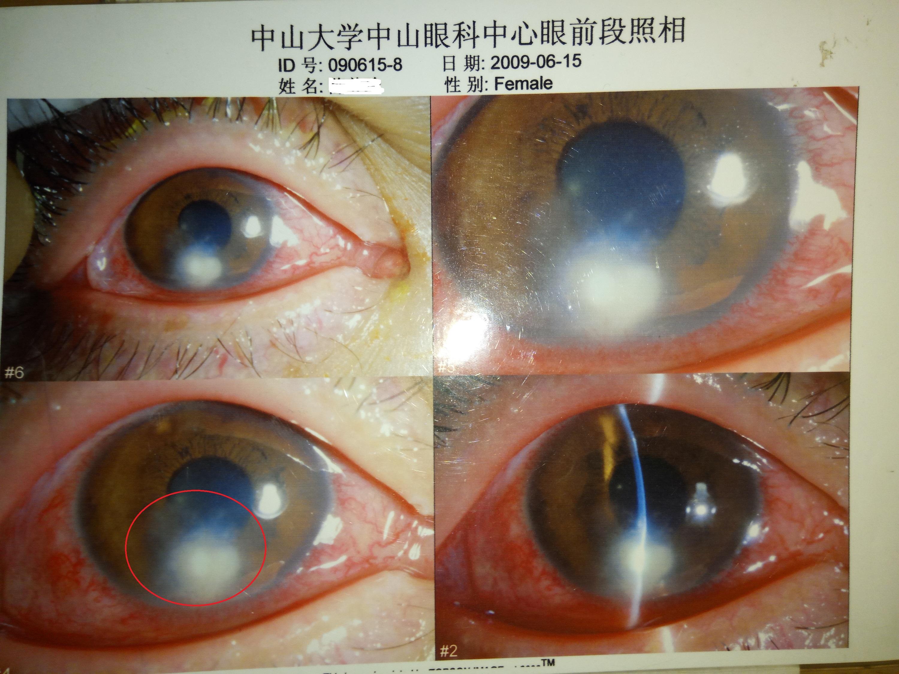 角膜炎和正常眼睛图片图片