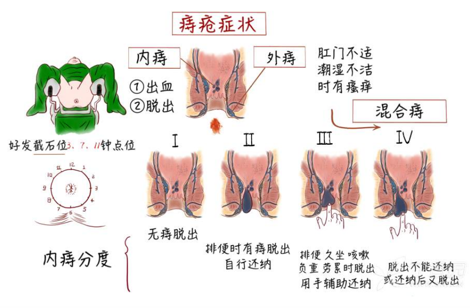 痔瘡的症狀有哪些?