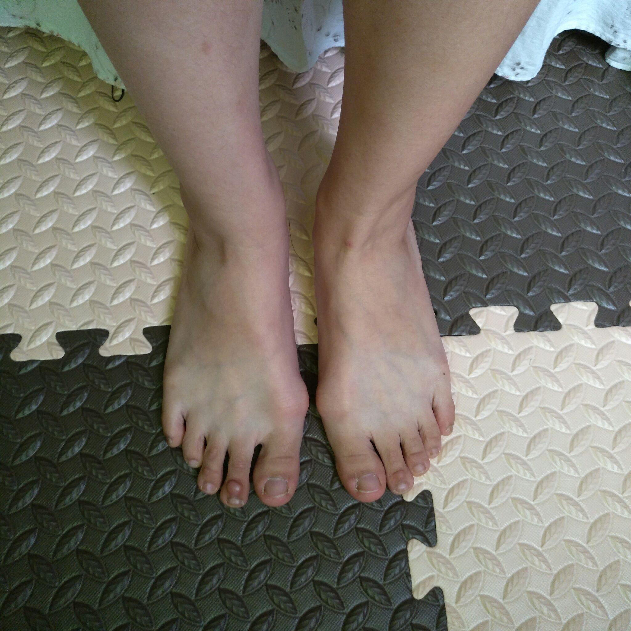 作为一个女生脚拇指外翻是一种怎样的体验