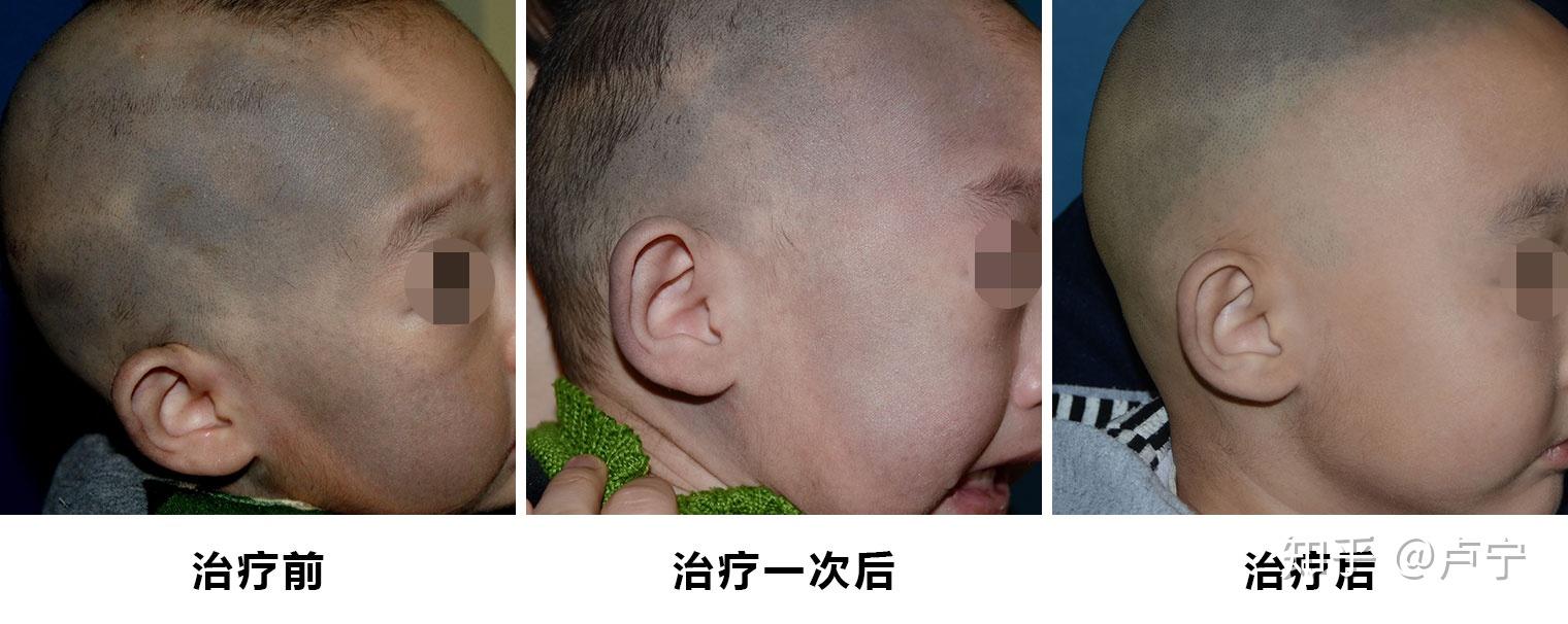 婴儿长太田痣? - 知乎