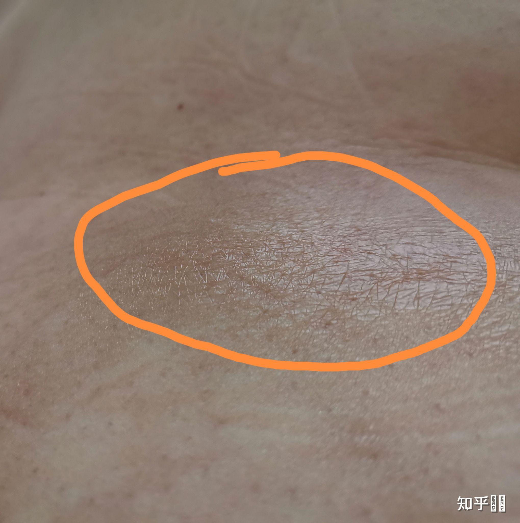 局限性硬皮病能活多久? - 知乎