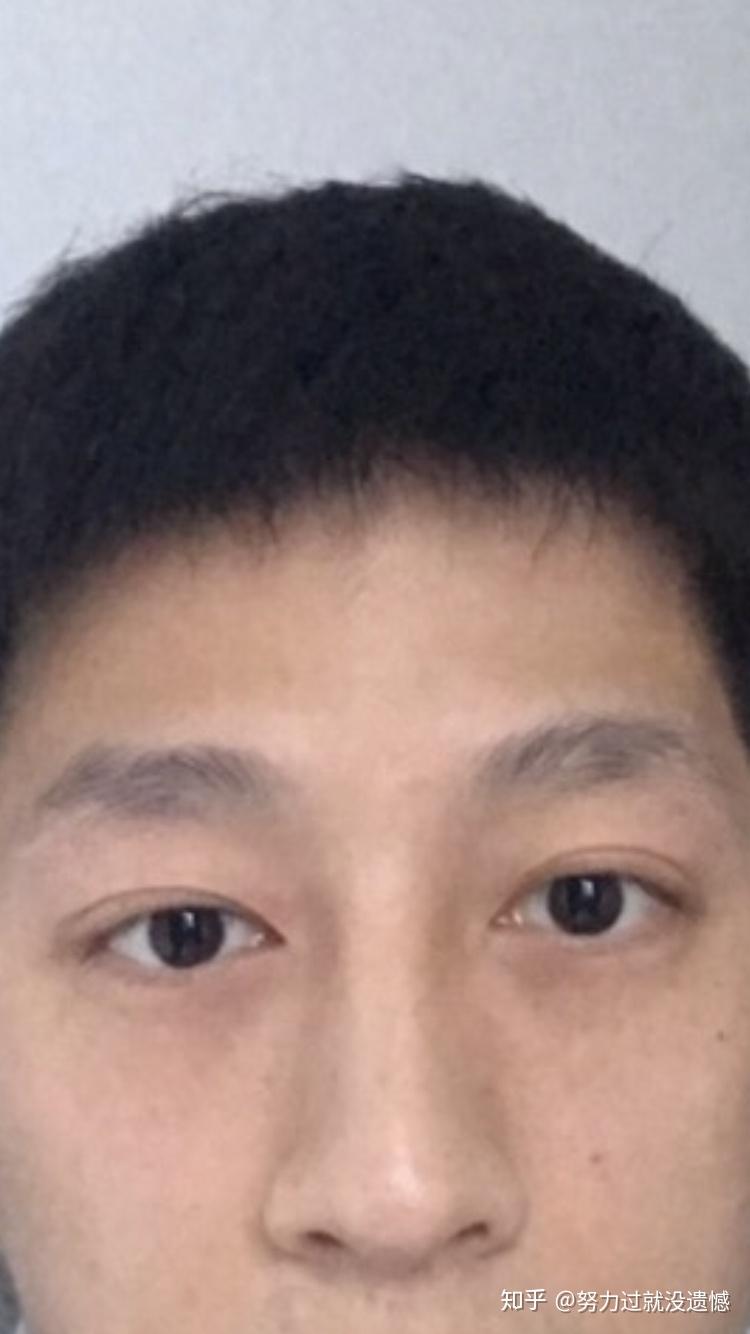 眼睛高低不对称怎么办? - 知乎