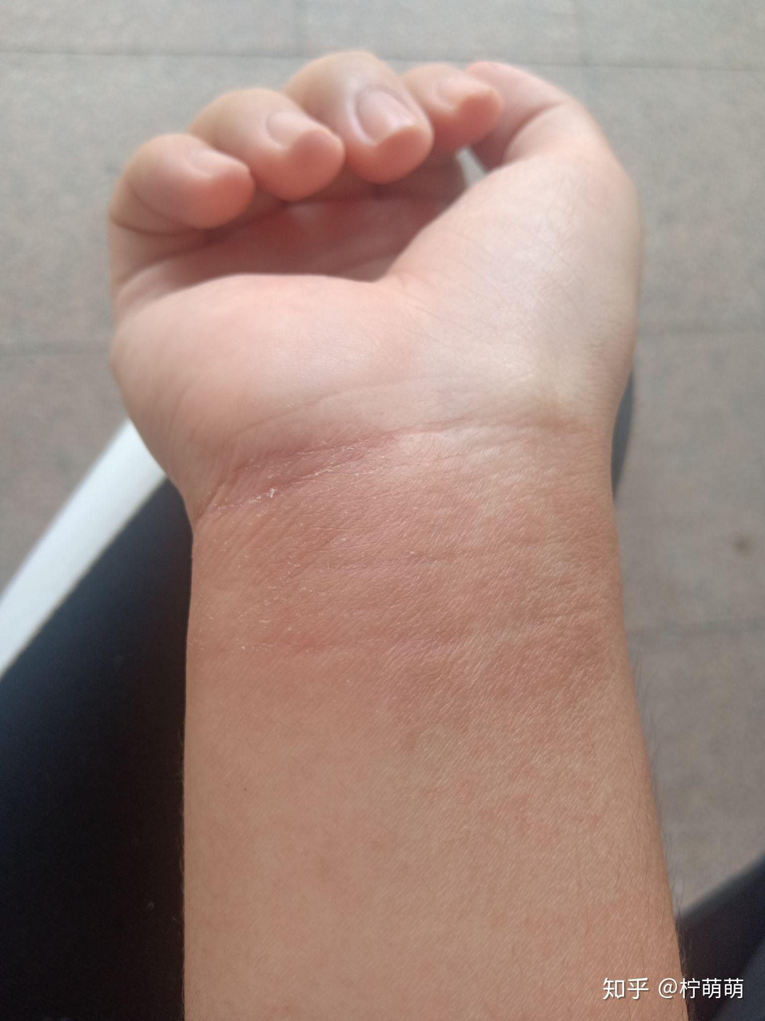 美发店洗头工的手为什么都会烂