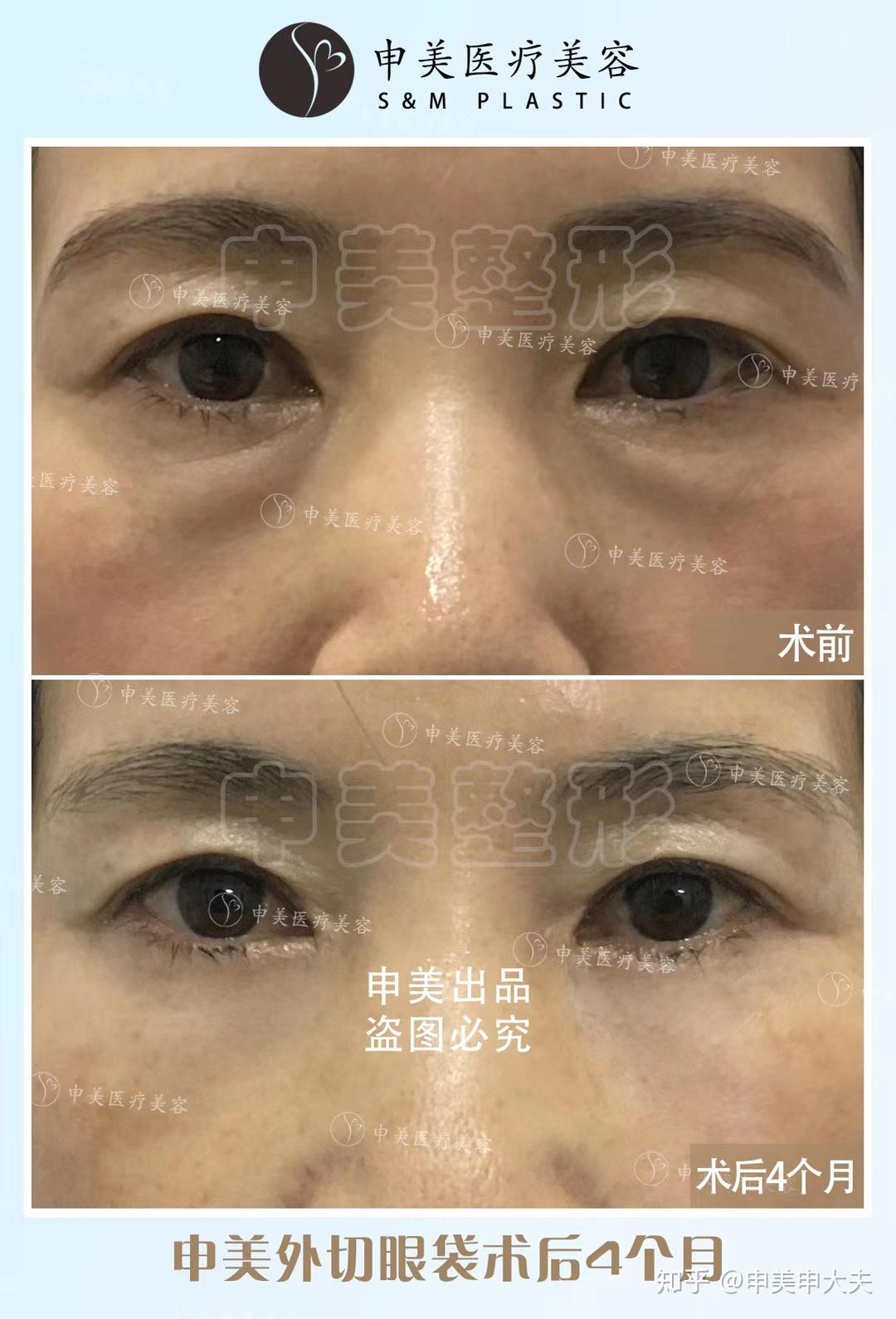 割眼带大恢复一共会花多少钱