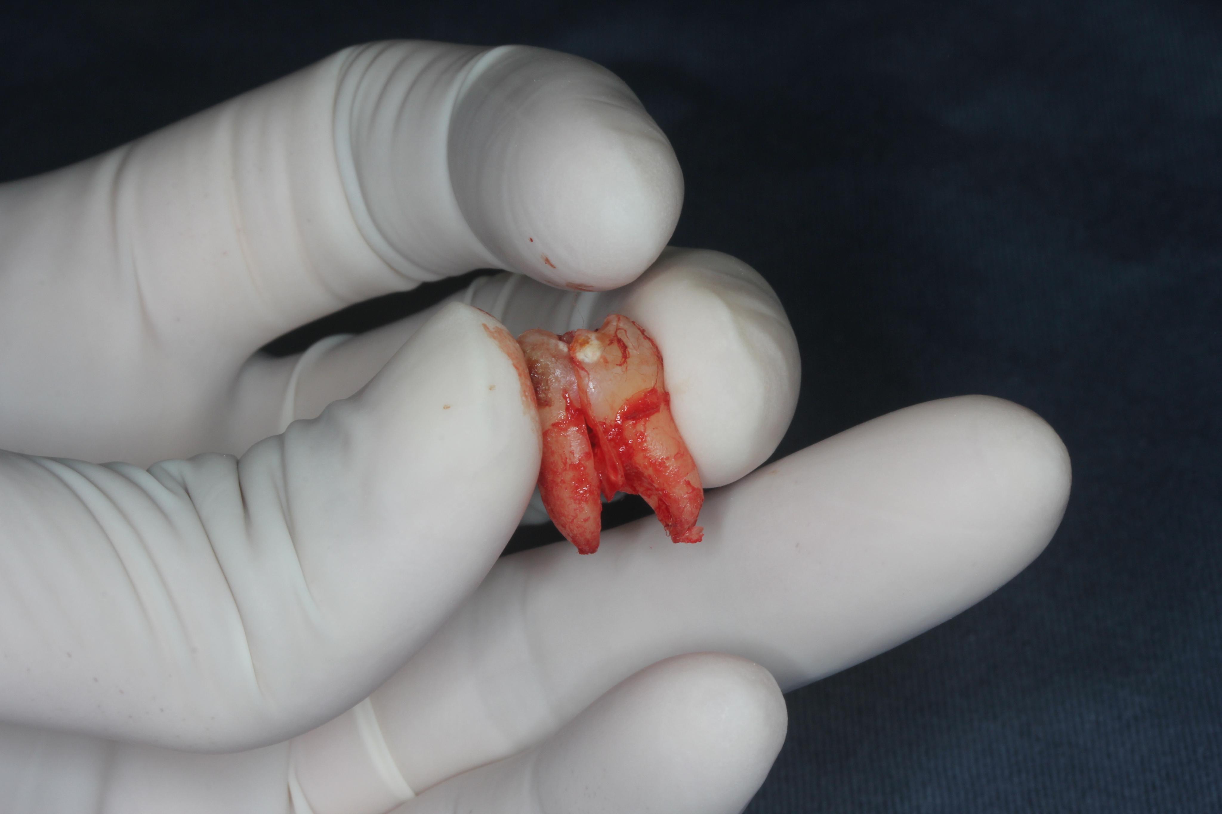 拔智齿有多痛? - 知乎