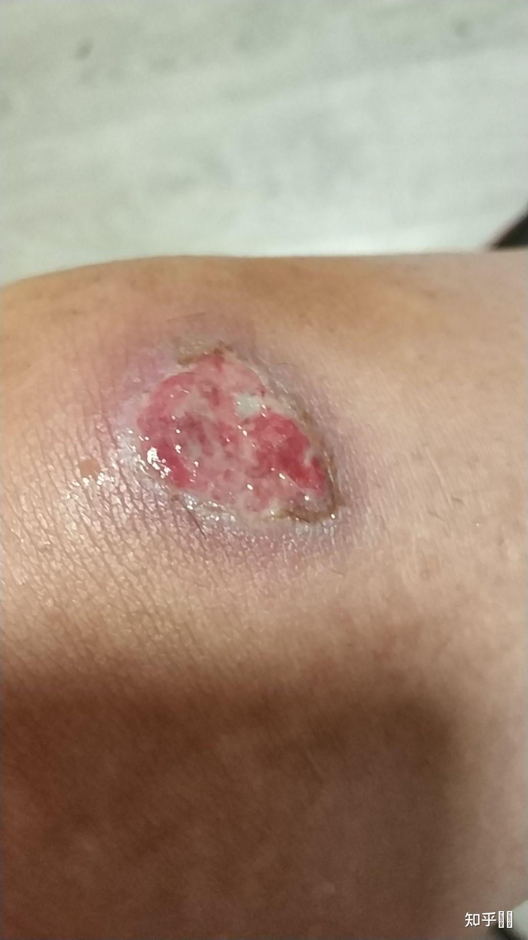 膝盖摔伤破了一大块皮流水抹云南白药好了一点三天后开始流水了咋办呢