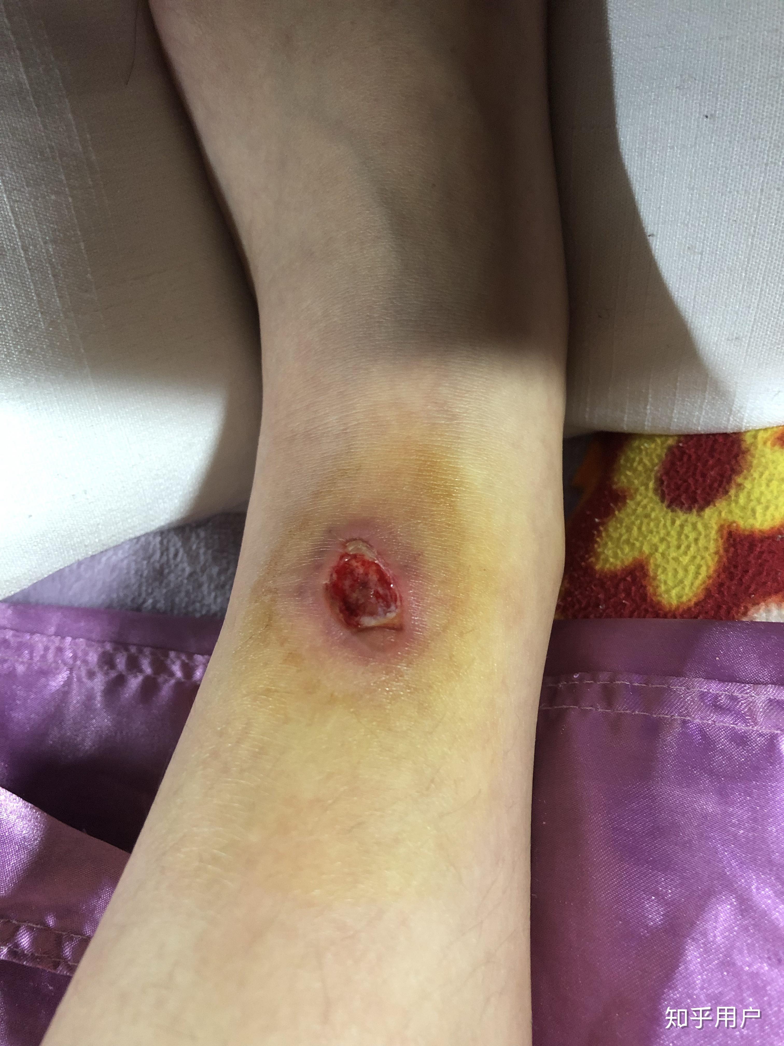 被毒蚊子咬了 肿了很大一个包 还很硬 之后肿的