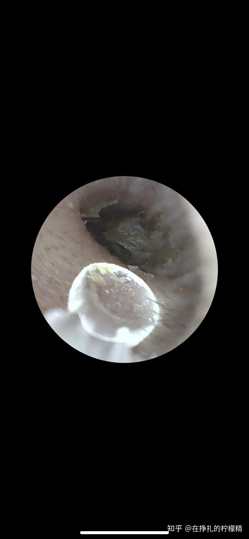有没有人购买和使用过可视内窥掏耳勺?是一种什么样的体验? - 知乎