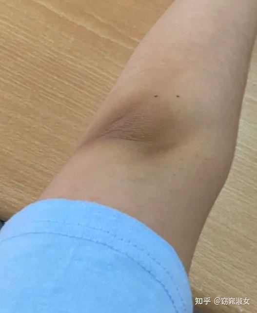 胳膊肘黑,洗澡搓不掉怎么办?