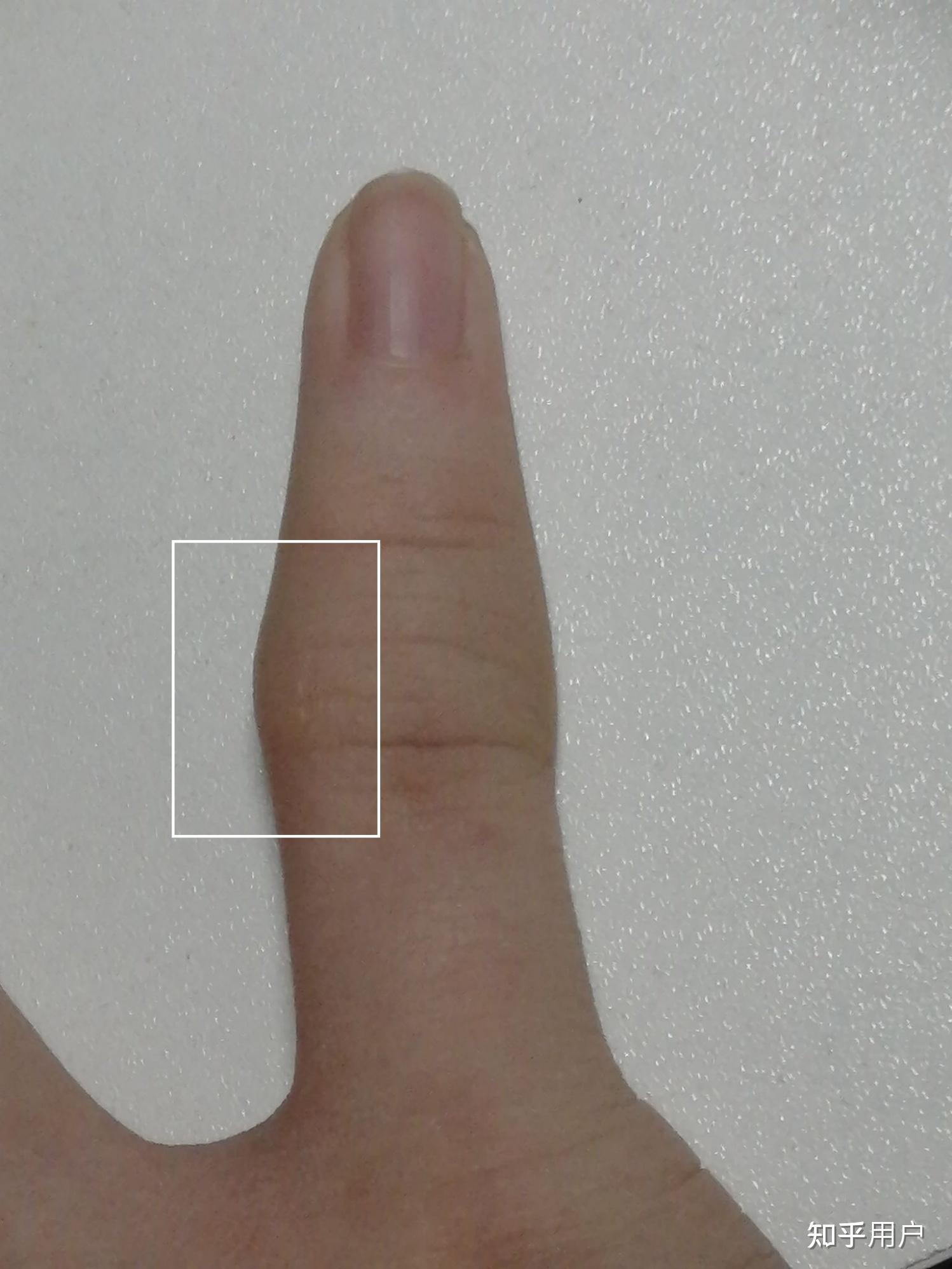 手指长歪了到底是什么情况