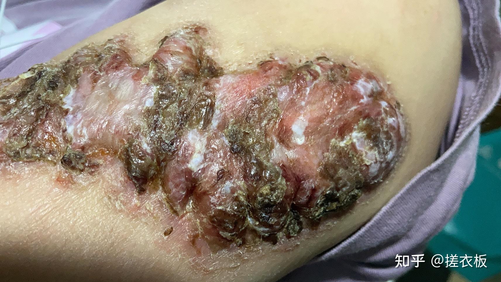 瘢痕体质的人这一生有什么样的体验? - 知乎