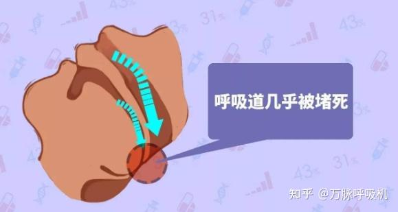 鼾症患者需要每晚使用呼吸机吗?每次一般要用几小时? - 知乎