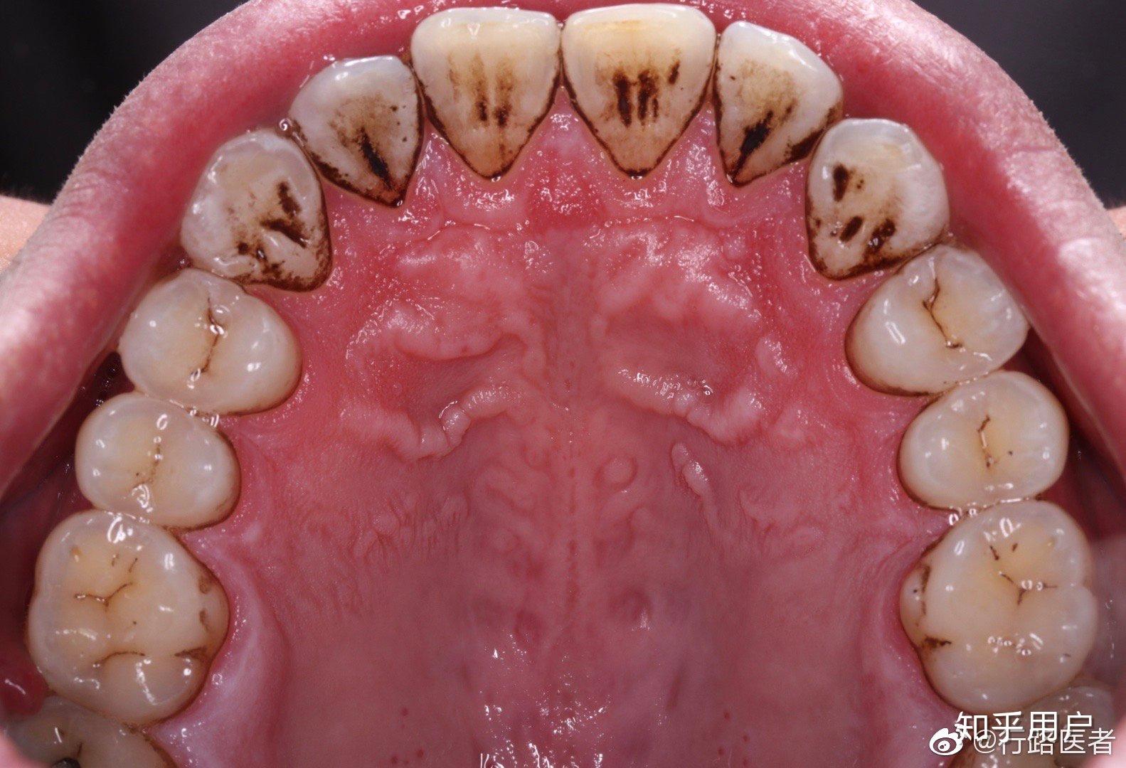 去洗牙牙结石严重会不会很尴尬