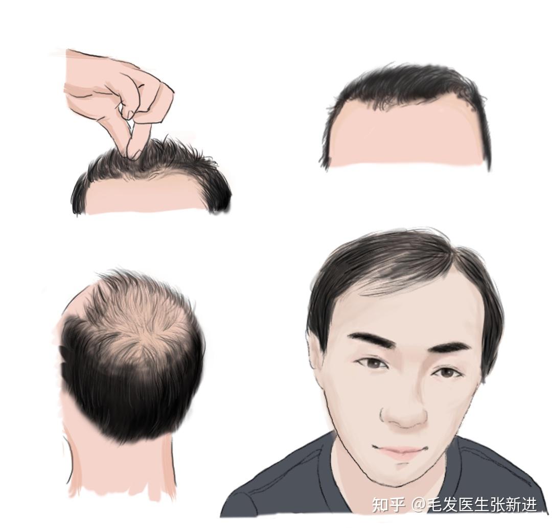 兄弟姐妹们只是秃头的前兆吗我好慌
