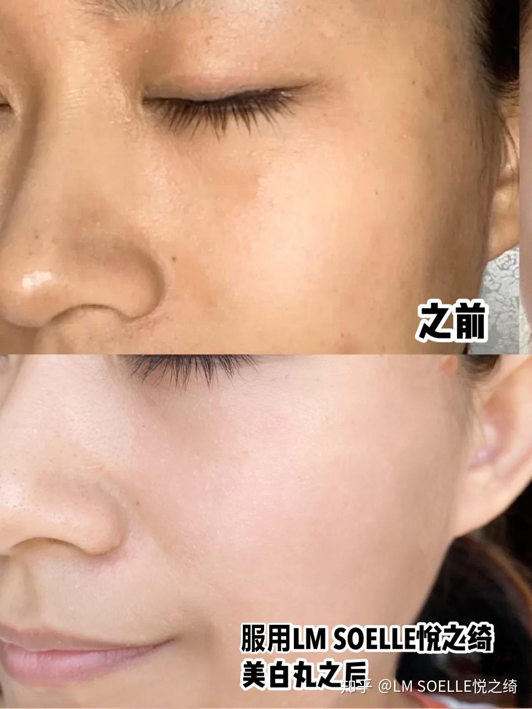淡斑攻略：美丽从这里开始