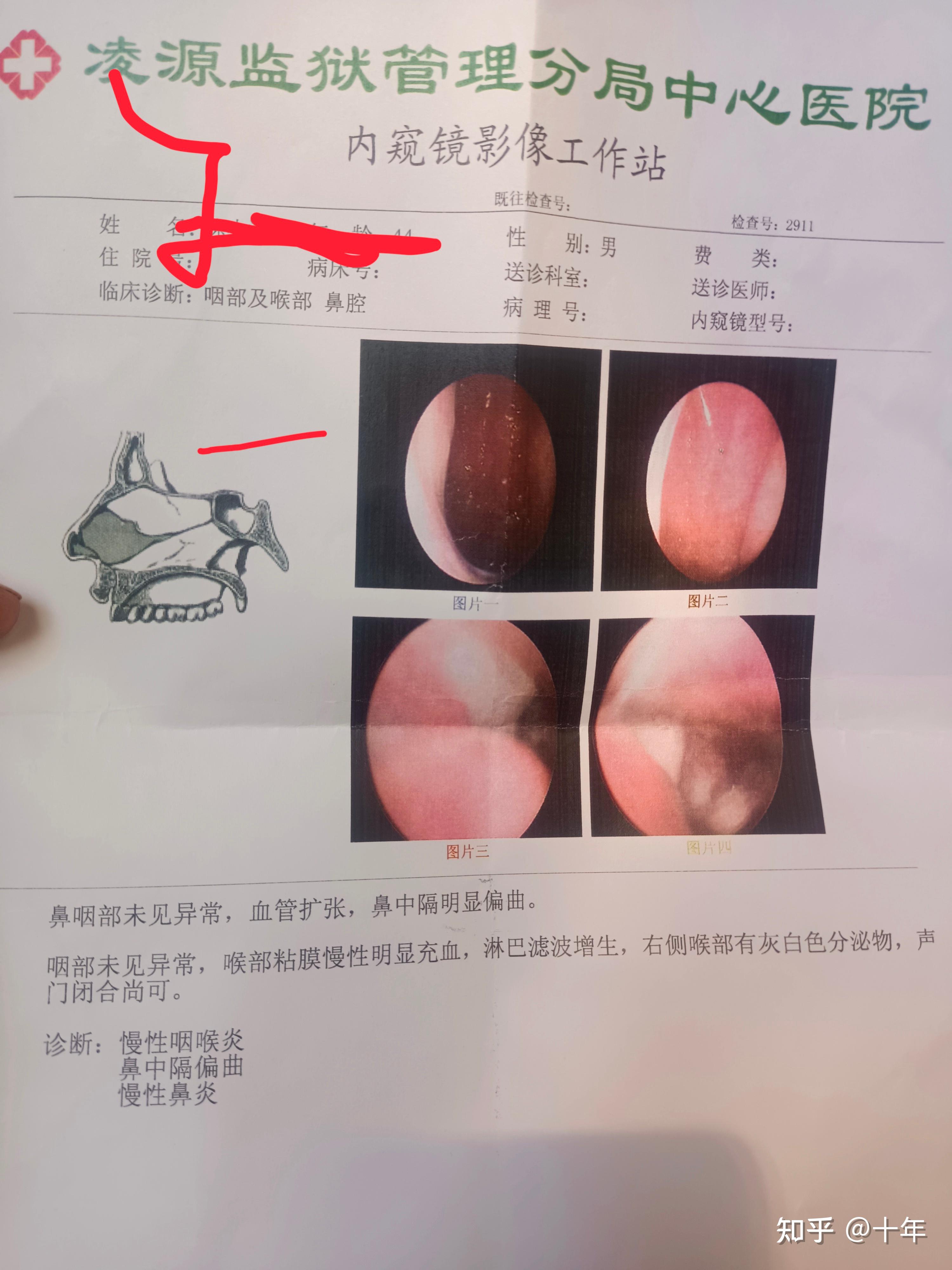 慢性咽喉炎,慢性咽喉炎! - 知乎