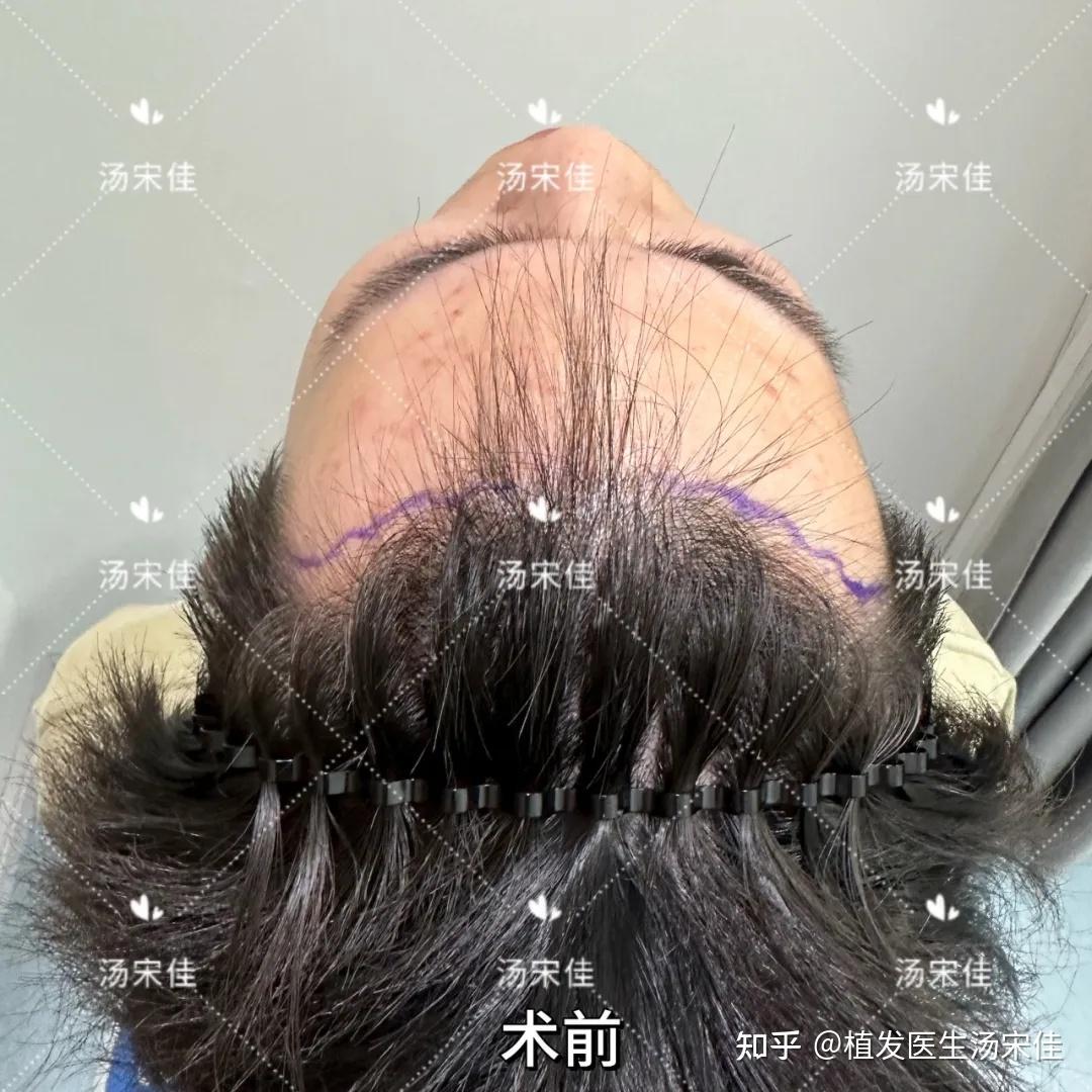 男性发际线植发1年,700毛囊单位 - 知乎