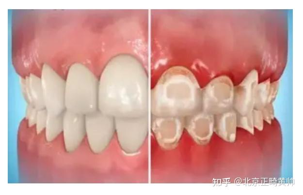 牙齿矫正之牙齿脱矿:脱矿原因 | 如何预防 | 如何治疗 - 知乎