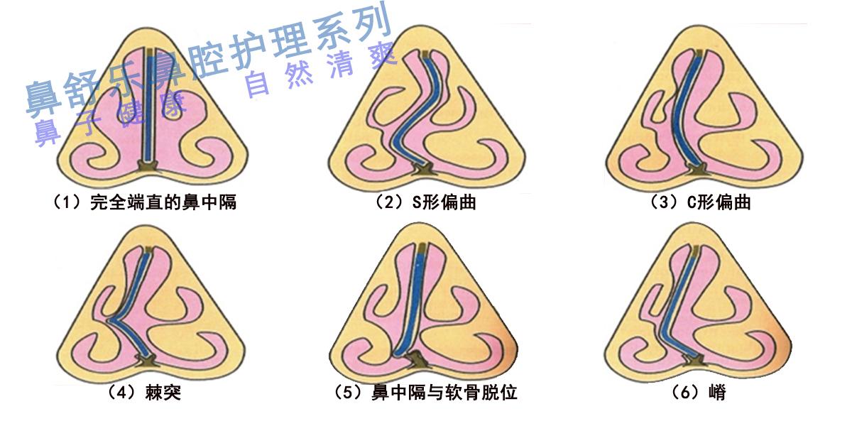 你的鼻炎后来是如何好的?前提是不手术不吃药的情况下? - 知乎