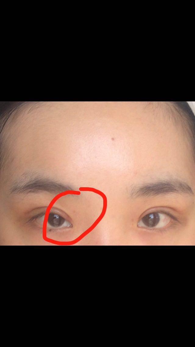 开眼角一个月增生严重,需要用美皮护和疤克吗?怎么挽救,求支招⊙⊙!