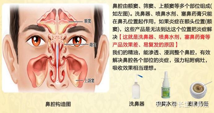 鼻窦炎注意什么? - 知乎