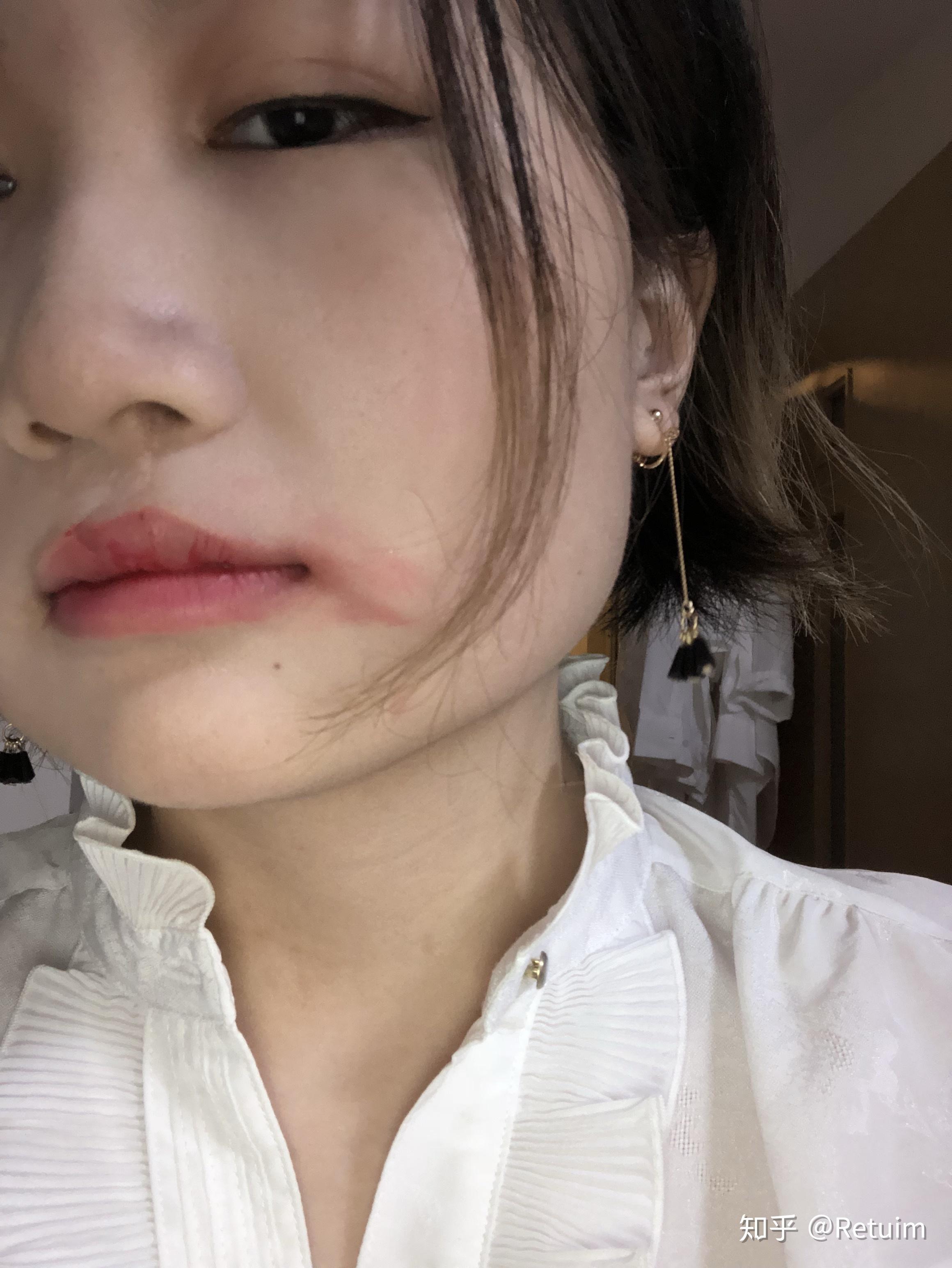 先天性兔唇的人在社会上都过得怎么样? - 知乎