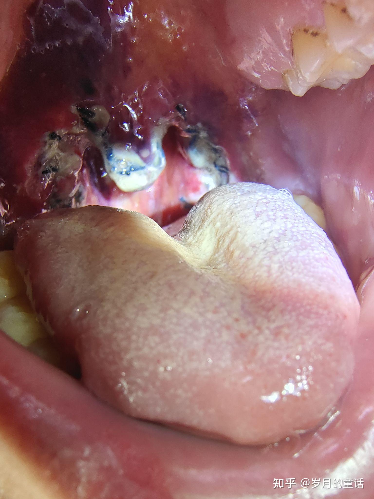 请问做扁桃体切除术需要一起做腭咽成形术吗? - 知乎
