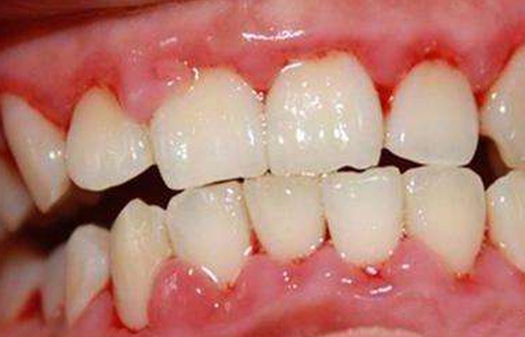 牙龈炎真人图片图片