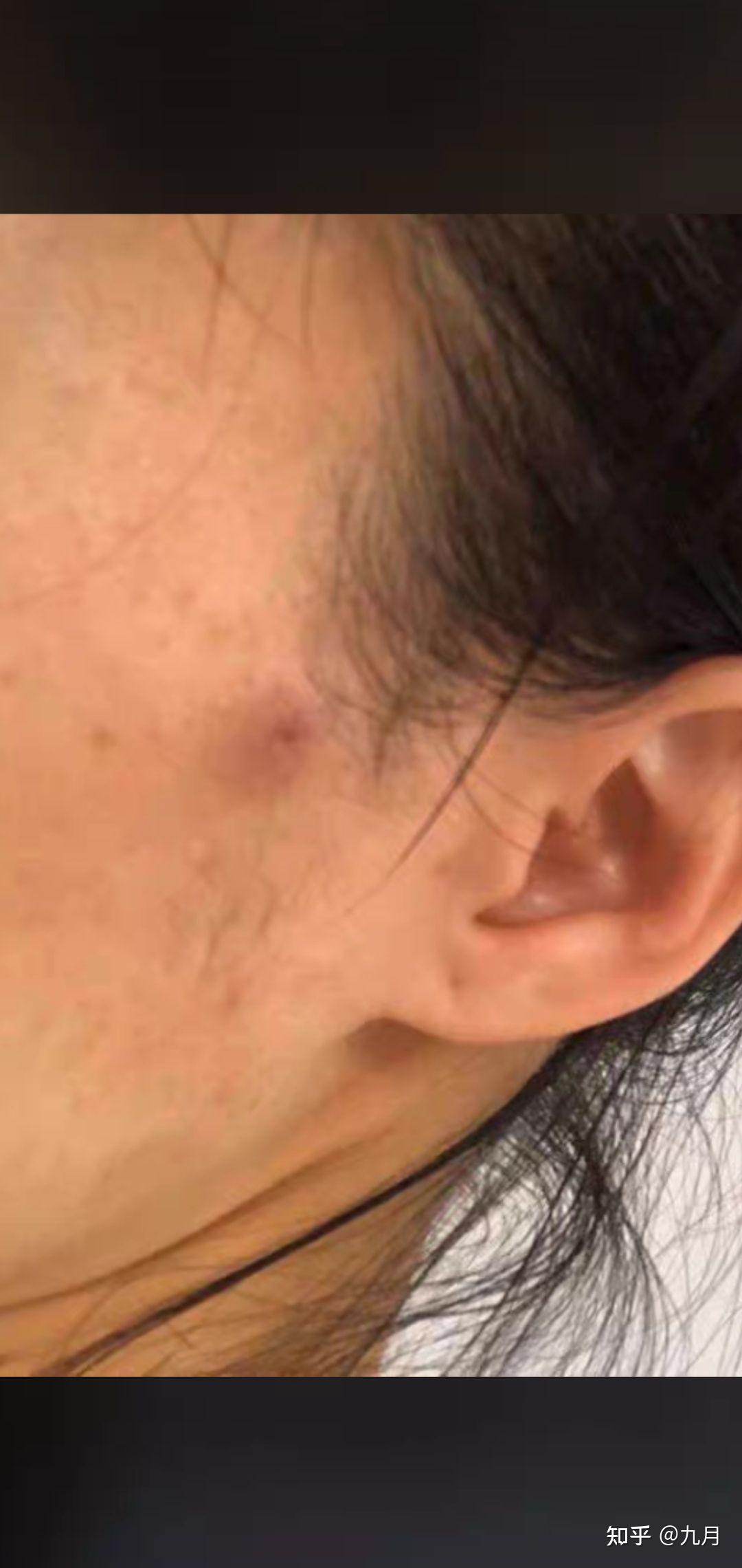 火疖子 皮脂腺囊肿 粉瘤 - 知乎