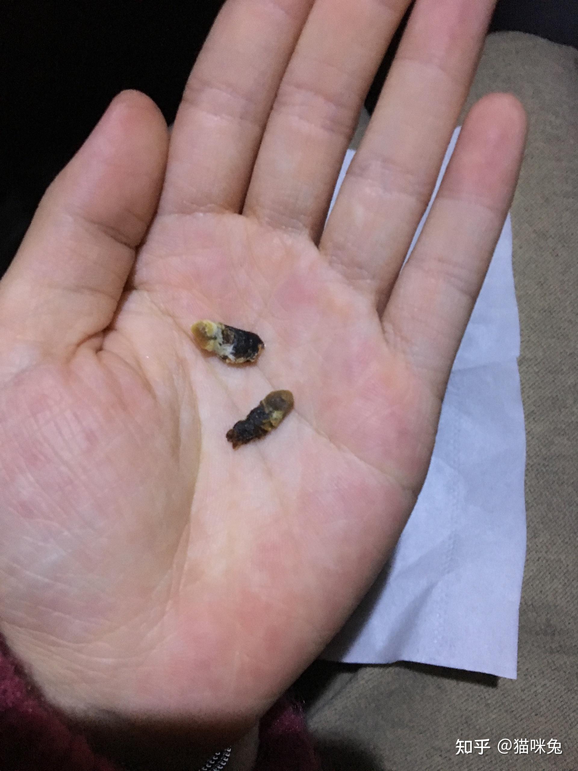 耳屎能大到什么程度