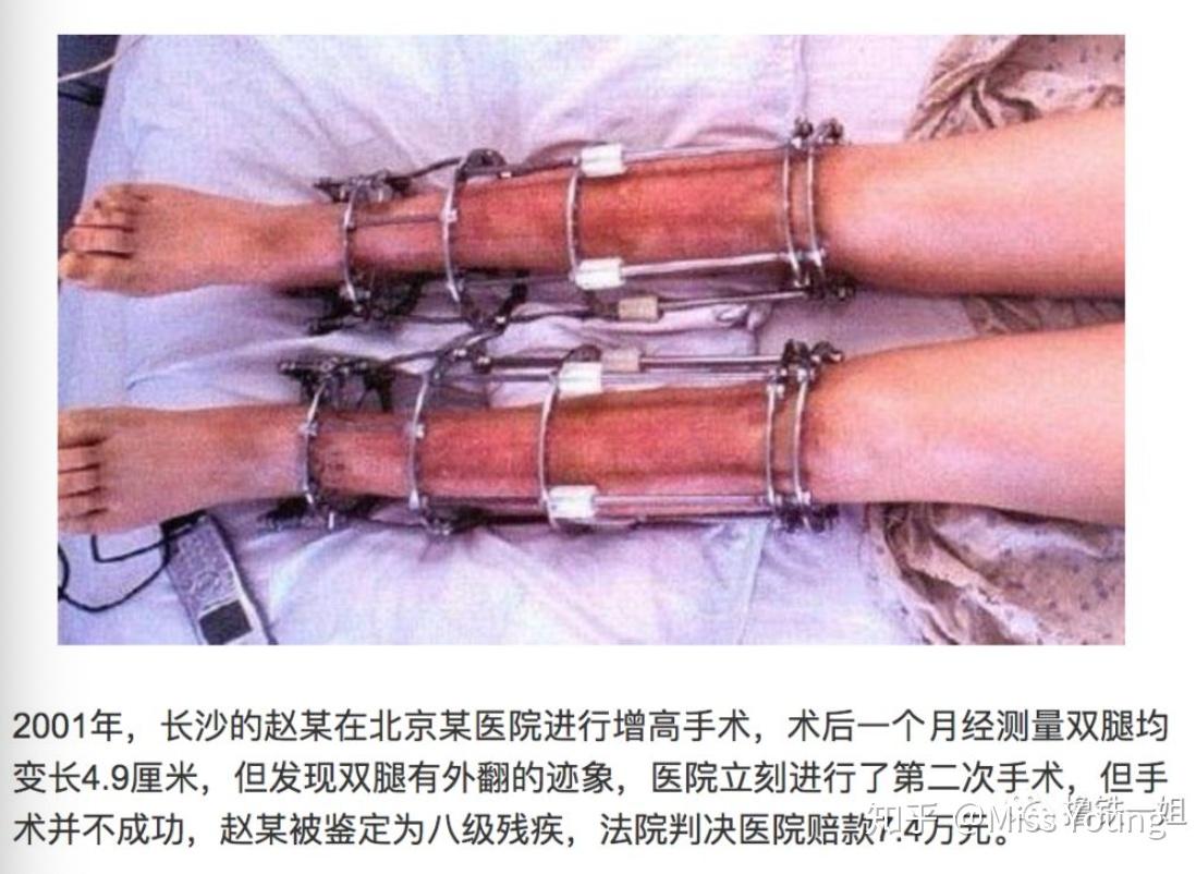 中国断骨增高第一人图片
