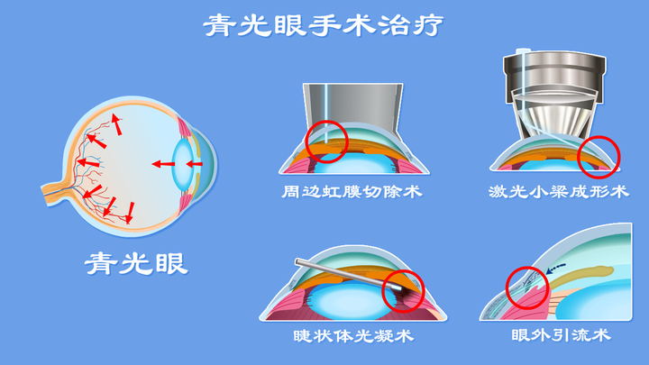 青光眼的治疗选购指南：如何选择适合自己的疗法