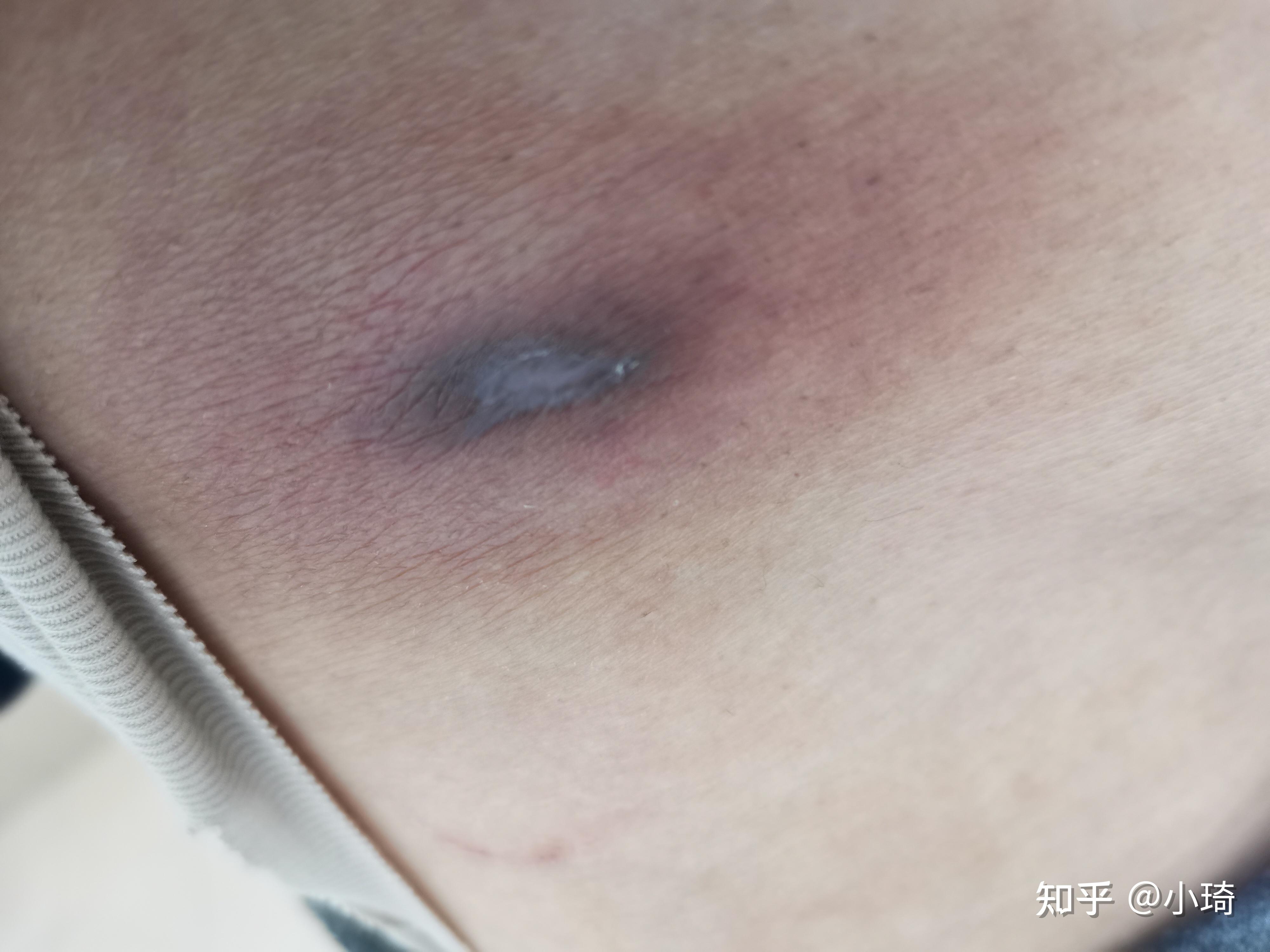 我的火疖子治疗历程:从痛苦挣扎到看见治愈的希望 - 知乎