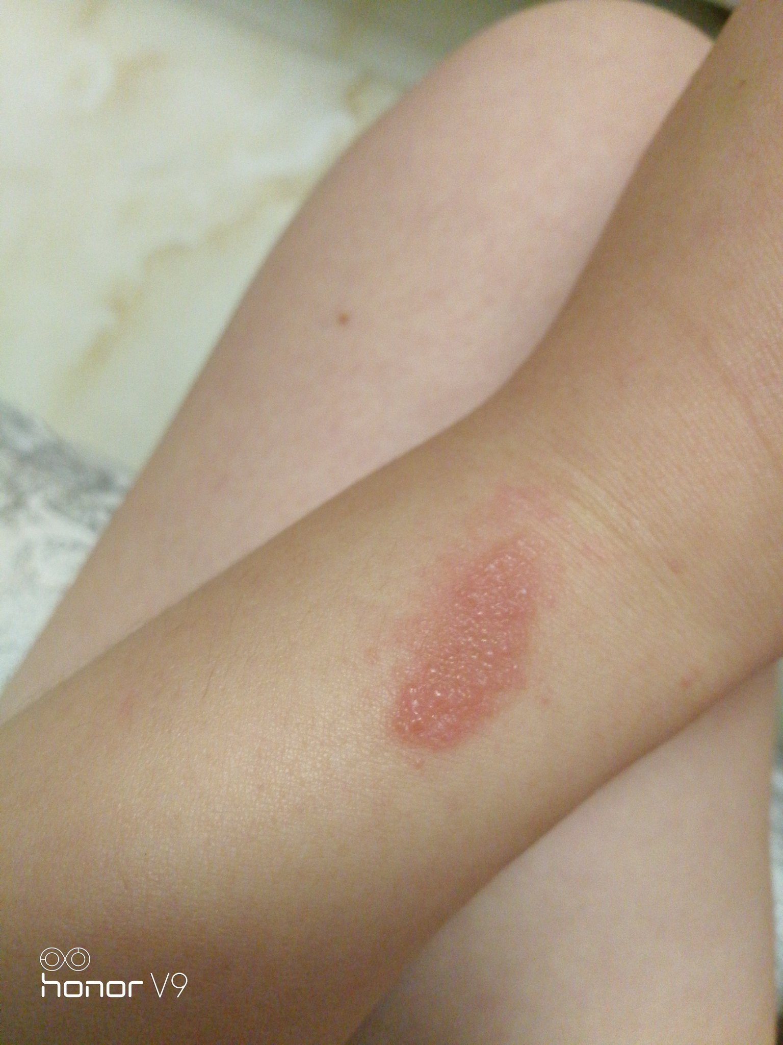 为什么我被蚊子咬了之后会肿而且会起水泡发热还发硬一大片