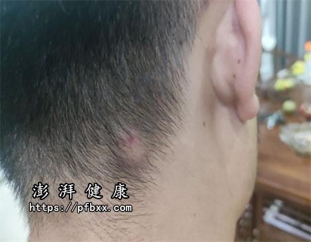 背上长了红色的痘痘发痒是什么原因 - 知乎