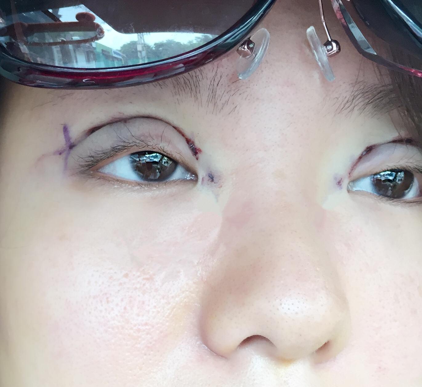 割双眼皮失败是什么样子的? - 知乎