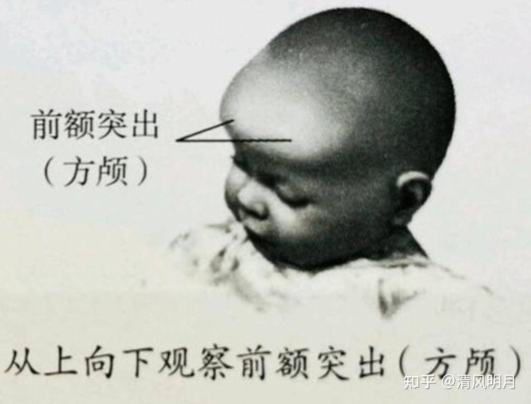 维生素 d 依赖性佝偻病的常见症状表现有什么?