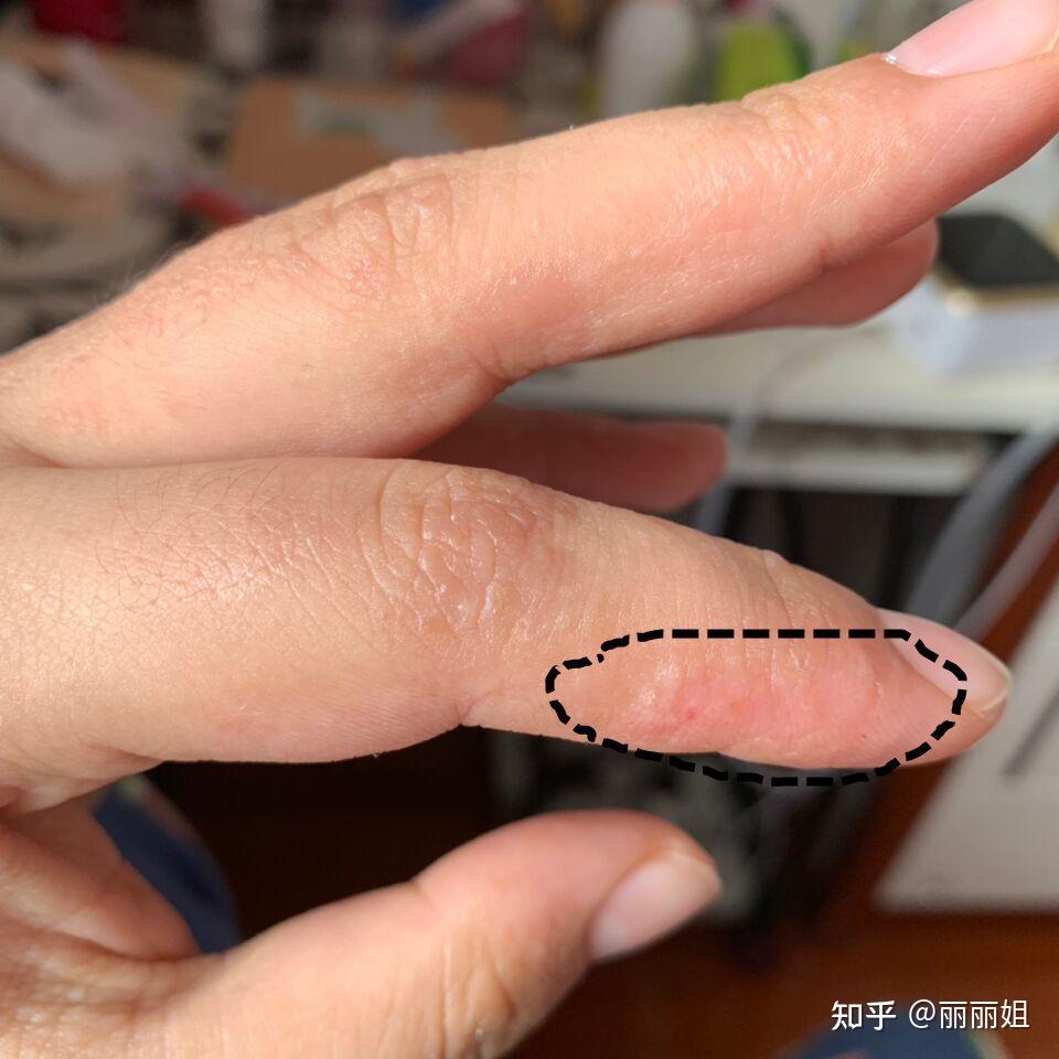 汗疱疹水泡呈蜂窝状