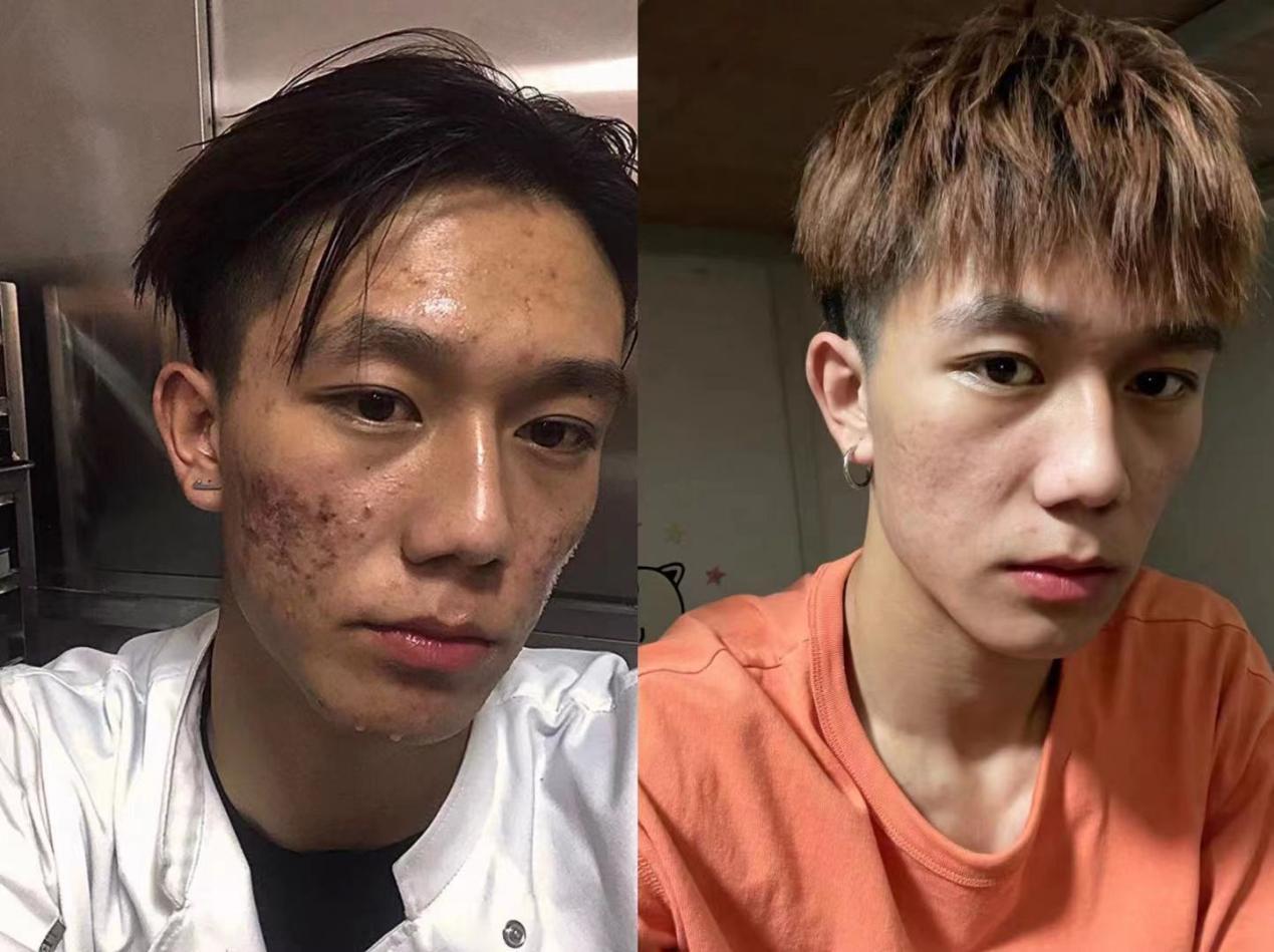 你们会找一个满脸痘坑的男朋友或者女朋友吗