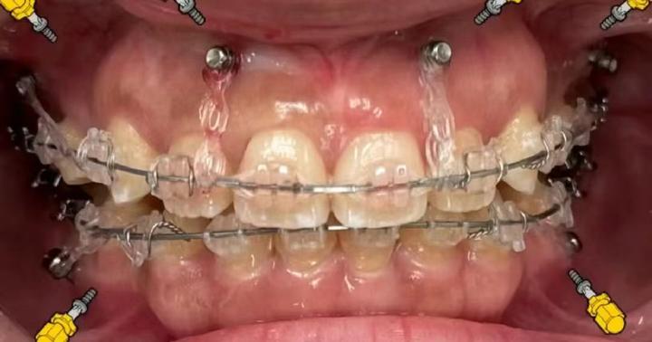 牙齿矫正,打支抗钉(骨钉)是一种怎样的体验(下)?
