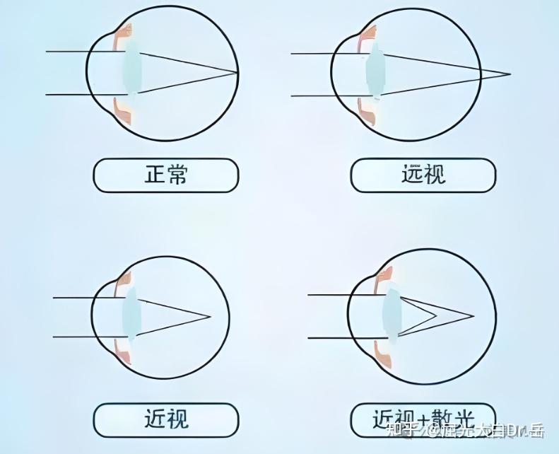 散光是屈光不正的一种,指眼球在不同子午线上的屈光力不同,平行光线